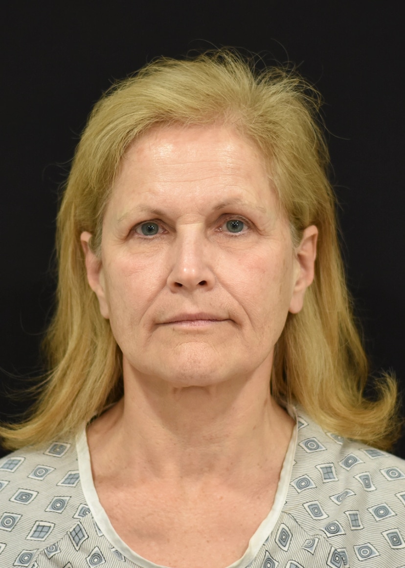 Extended Deep Plane Facelift Patient 12 Set 1 Before
