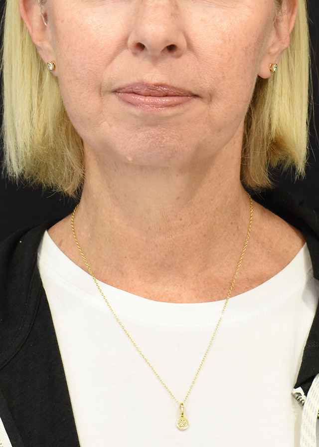 Deep Plane Facelift Patient 18 - Set 1 - After